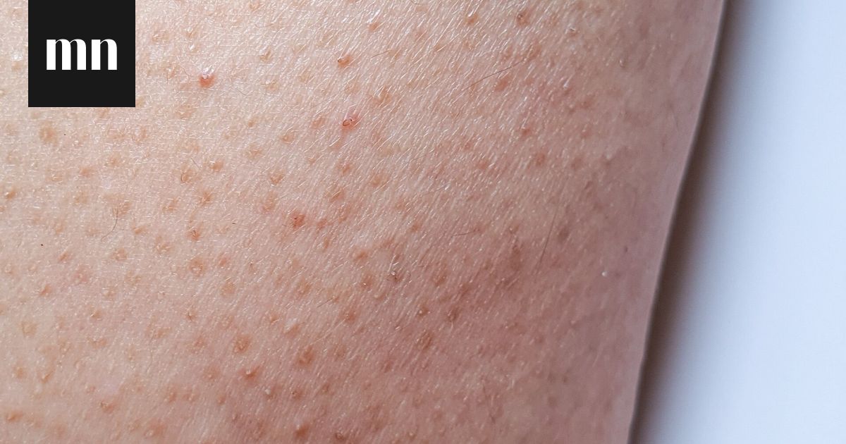 Pieni Punaisia Pilkkuja Ymp ri Kehoja Ihotautil k rit Kertovat pieni-punaisia-pilkkuja-ymp-ri-kehoja-ihotautil-k-rit-kertovat