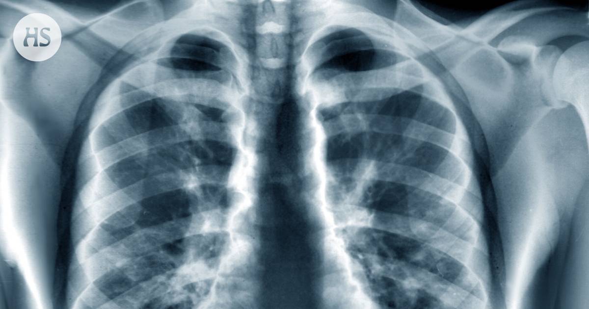 The new combination of drugs stopped the progression of lung cancer for almost two years