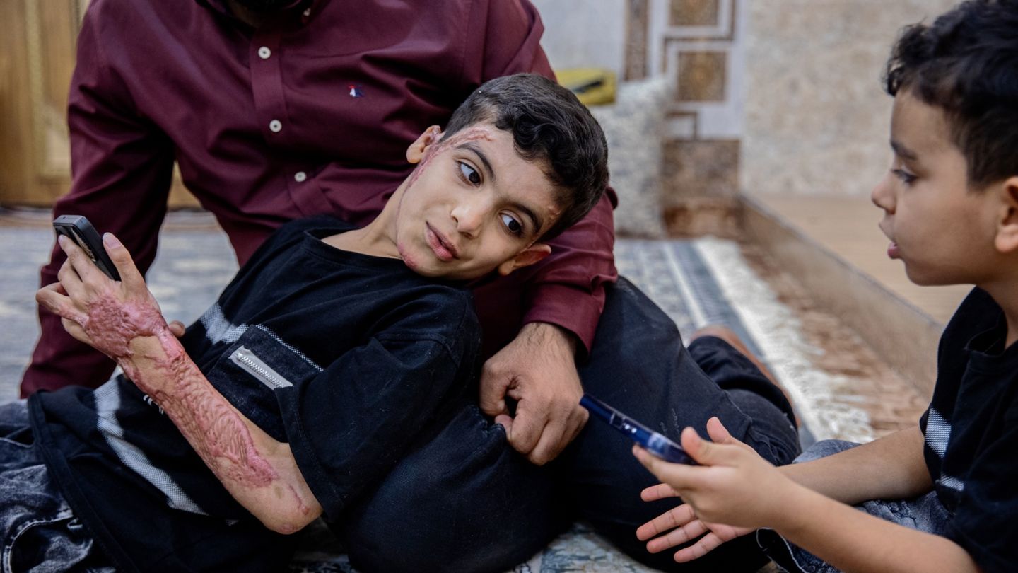 Iranin sodan arvet | Sodan hinta näkyy Mohammed Sharafin, 8, iholla, eivätkä suuret lupaukset avusta toteutuneet