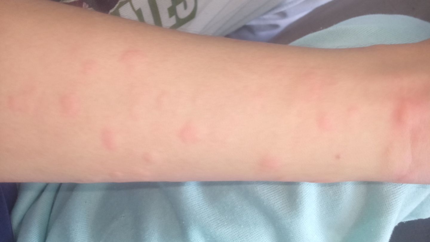 Focusing on skin irritation can reduce inflammation, study finds
