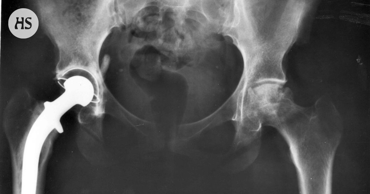 An artificial hip joint lasts for 25 years already, because the materials have improved