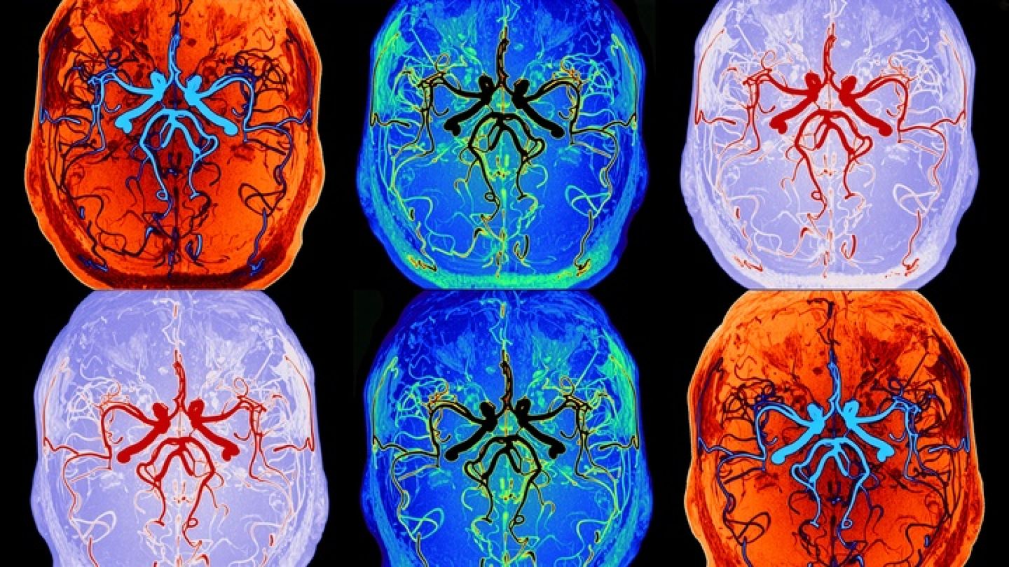Finnish Study May Enhance Brain 'Washing Machine' Monitoring