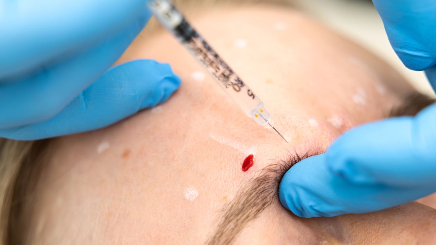 Anyone Can Inject Fillers: Aesthetic Treatment Regulation Leaves Consumers Vulnerable