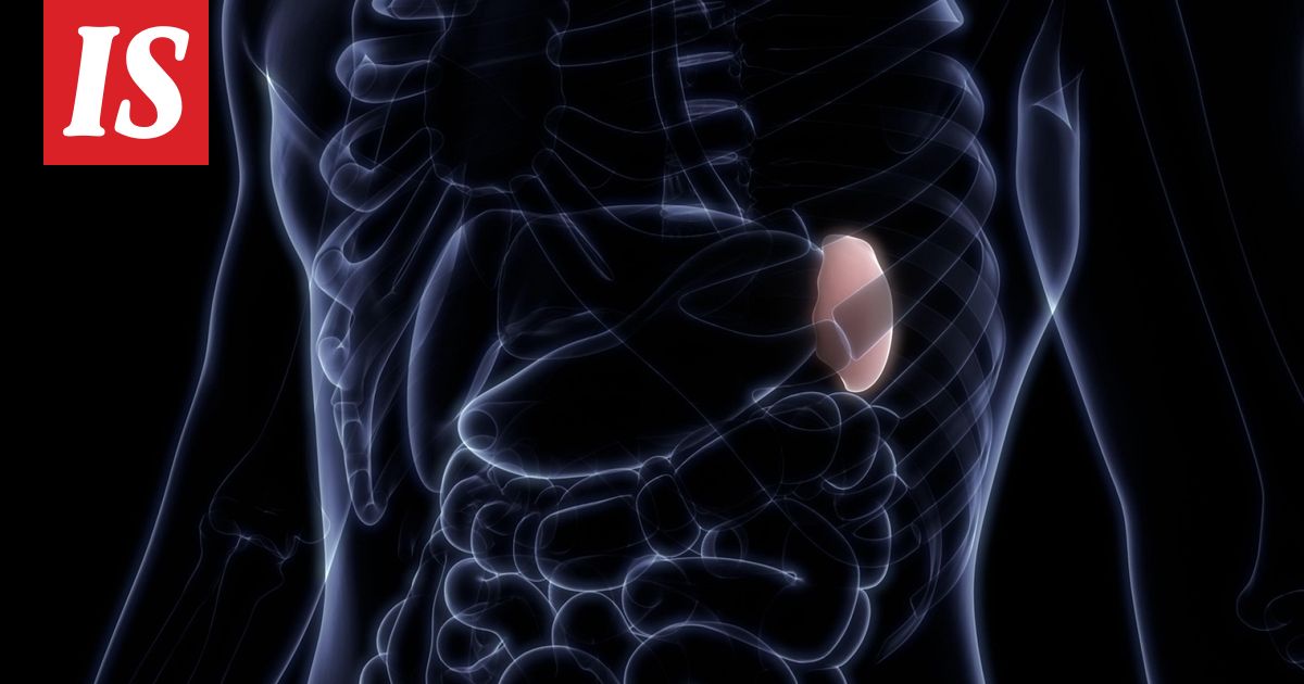 Kirurgi poisti väärän elimen leikkauksessa – mies kuoli