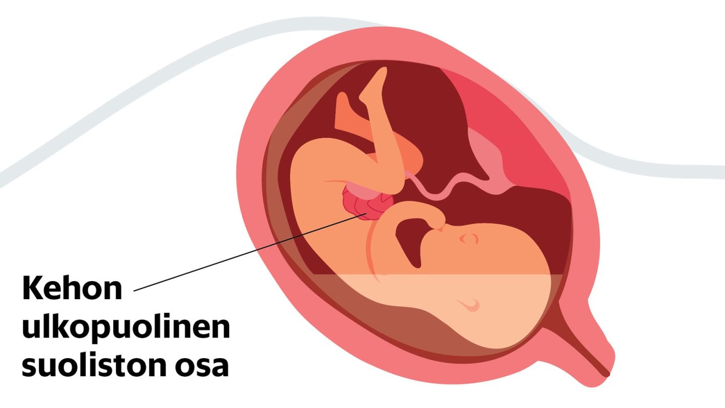 Fetus with severe defect surgically treated in womb, baby born healthy