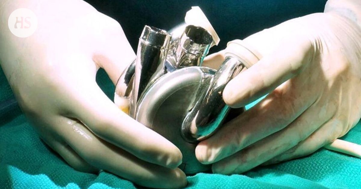 Artificial Heart pumped a record a hundred days in a man’s chest