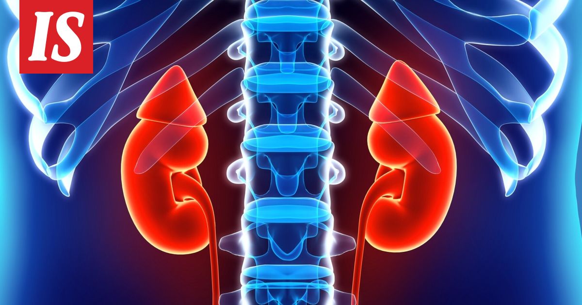 Harmittomalta tuntuva tapa ruoka­pöydässä voi johtaa jopa munuais­tautiin