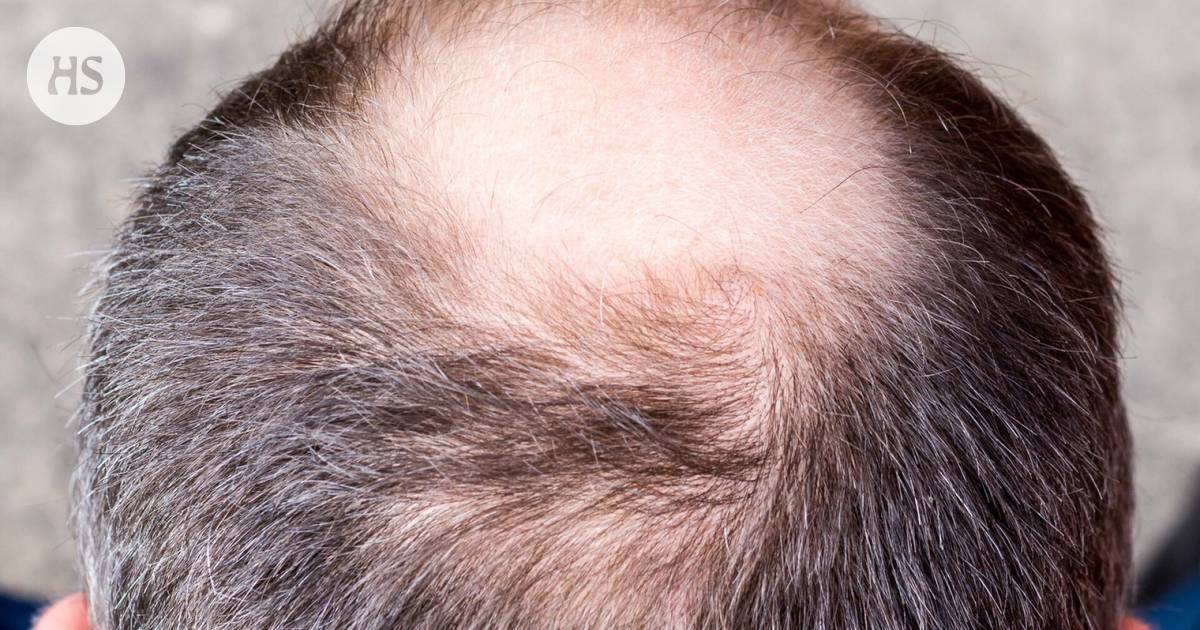 The European Medicines Agency is investigating whether a popular baldness drug causes suicide